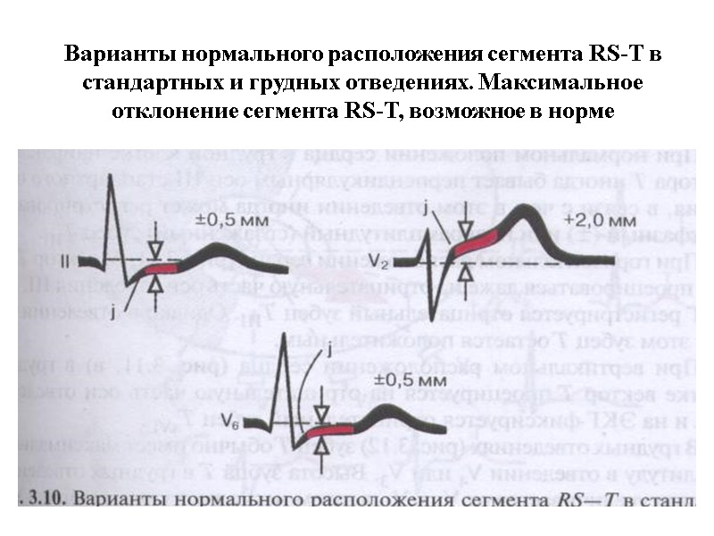 Варианты нормального расположения сегмента RS-T в стандартных и грудных отведениях. Максимальное отклонение сегмента RS-T,